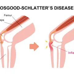 Ilustracja pokazuje rozwój choroby Osgood-Schlatter. Po lewej zdrowa anatomia kolana, po prawej zapalenie więzadła rzepki.