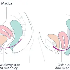 Porównanie prawidłowego i osłabionego dna miednicy z widoczną macicą.
