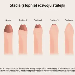 Ilustracja pokazuje stadia rozwoju stulejki, od normy do stadium 4, gdzie widoczne są trudności z oddawaniem moczu.
