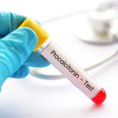Ręka w niebieskiej rękawiczce trzyma probówkę z napisem "Procalcitonin - Test".