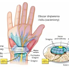 Anatomia dłoni z zaznaczonym nerwem pośrodkowym i więzadłem poprzecznym. Kość promieniowa jest częścią nadgarstka.
