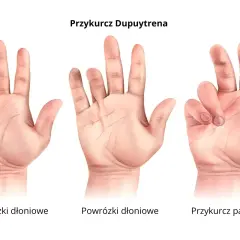 Trzy dłonie pokazujące postęp przykurczu Dupuytrena: zdrowe, z powrózkami i z przykurczem palców.