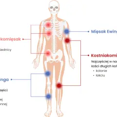 Schemat pokazuje lokalizację mięsaków: chrzęstniakomięsak w miednicy, żebrach, łopatkach; kostniakomięsak w kolanach, łokciach; mięsak Ewinga w piszczeli, kościach udowej i ramiennej.