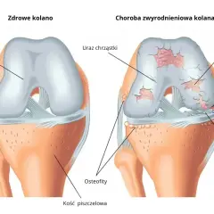 Porównanie zdrowego kolana z kolanem dotkniętym chorobą zwyrodnieniową, ukazujące uszkodzenia chrząstki i kości.