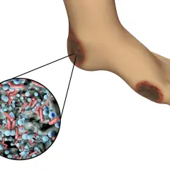 Stopa z ranami, które mogą być objawem gangreny. Powiększenie pokazuje bakterie odpowiedzialne za infekcję.