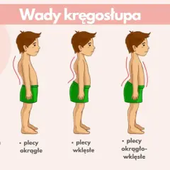 Ilustracja pokazuje wady kręgosłupa: plecy okrągłe, wklęsłe, okrągło-wklęsłe i płaskie. Lordoza to nadmierne wygięcie kręgosłupa.