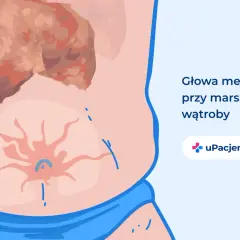 Ilustracja przedstawia objawy marskości wątroby, takie jak "głowa meduzy" na brzuchu. Dzięki leczeniu, wyleczyłem marskość wątroby.