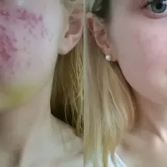 Przed i po kuracji Accutane: skóra z trądzikiem i zaczerwienieniami po lewej, gładka i czysta po prawej.