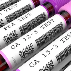 Rząd probówek z próbkami krwi do badań, z etykietami: CEA TEST, PSA TEST, CA 12-5 TEST, CA 15-3 TEST.