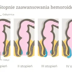 Ilustracja przedstawia cztery stopnie zaawansowania żylaków odbytu, od I do IV, pokazując ich stopniowe powiększanie się.