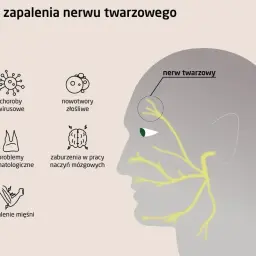 Ilustracja przedstawia schematyczne przyczyny zapalenia nerwu twarzowego: wirusy, nowotwory, problemy stomatologiczne, zaburzenia naczyń mózgowych i zapalenie mięśni.