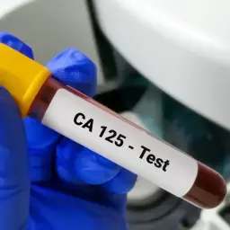 Rękawiczka w niebieskiej rękawicy trzyma probówkę z krwią z etykietą "CA 125 - Test". To badanie pomaga ocenić stan zdrowia.