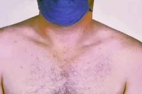 Skóra klatki piersiowej i szyi z licznymi, drobnymi, czerwonymi plamkami, które mogą być objawem tyfusu.
