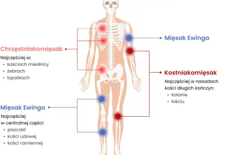 Schemat pokazuje lokalizację mięsaków: chrzęstniakomięsak w miednicy, żebrach, łopatkach; kostniakomięsak w kolanach, łokciach; mięsak Ewinga w piszczeli, kościach udowej i ramiennej.