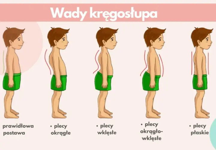 Ilustracja pokazuje wady kręgosłupa: plecy okrągłe, wklęsłe, okrągło-wklęsłe i płaskie. Lordoza to nadmierne wygięcie kręgosłupa.