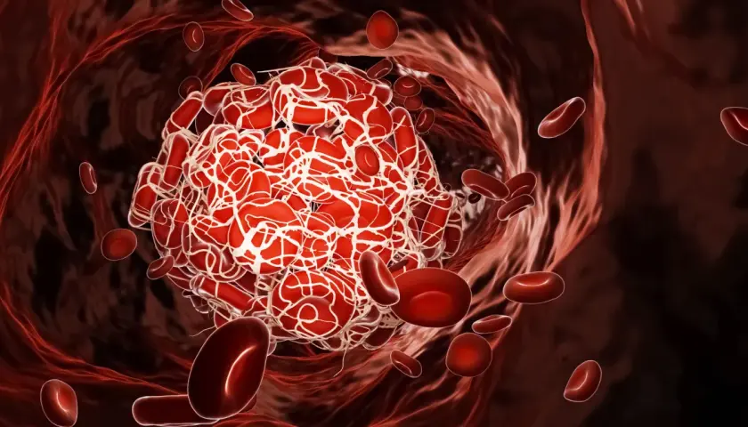 Skrzep krwi z czerwonymi krwinkami w naczyniu krwionośnym.