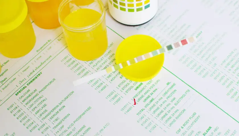 Żółte pojemniki na mocz, kubek z żółtym moczem i pasek testowy na papierze laboratoryjnym.