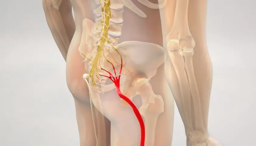 Anatomia nerwu kulszowego, kluczowego dla rwy kulszowej leczenie. Czerwony obszar wskazuje na potencjalny problem.