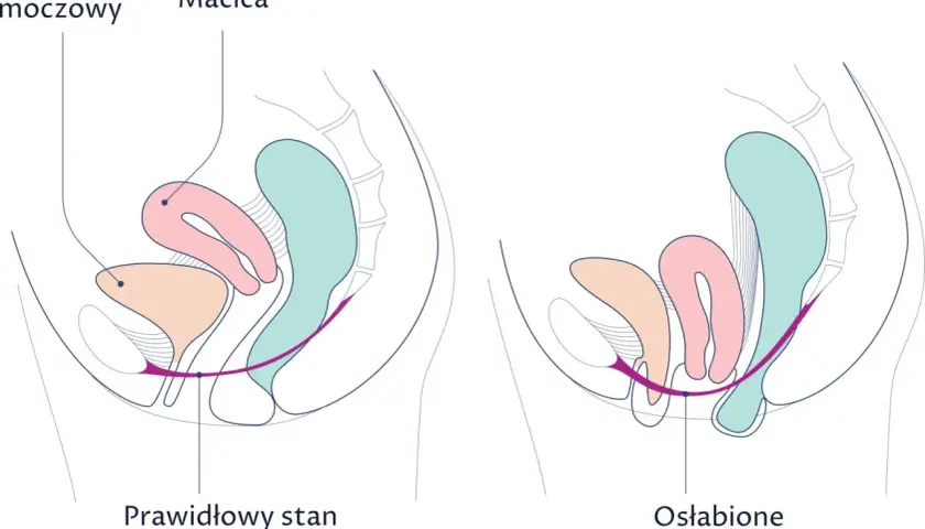 Porównanie prawidłowego i osłabionego dna miednicy z widoczną macicą.