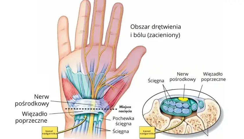 Anatomia dłoni z zaznaczonym nerwem pośrodkowym i więzadłem poprzecznym. Kość promieniowa jest częścią nadgarstka.