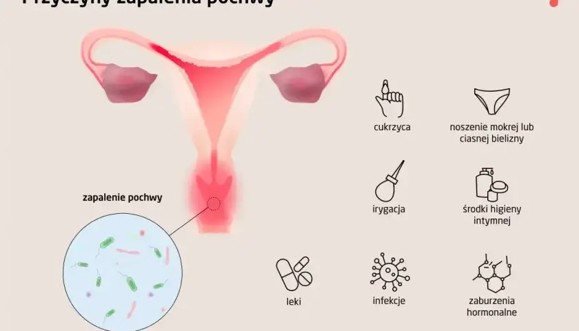 Ilustracja przedstawia przyczyny zapalenia pochwy, w tym cukrzycę, ciasną bieliznę, irygację, środki higieny intymnej, leki, infekcje i zaburzenia hormonalne.
