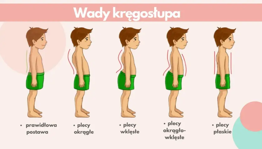 Ilustracja pokazuje wady kręgosłupa: plecy okrągłe, wklęsłe, okrągło-wklęsłe i płaskie. Lordoza to nadmierne wygięcie kręgosłupa.
