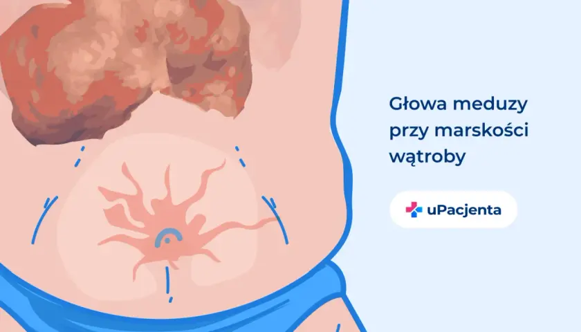 Ilustracja przedstawia objawy marskości wątroby, takie jak "głowa meduzy" na brzuchu. Dzięki leczeniu, wyleczyłem marskość wątroby.