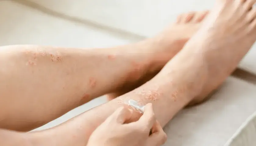 Osoba aplikuje krem locoid lipocream na skórę nóg z widocznymi zmianami łuszczycowymi.