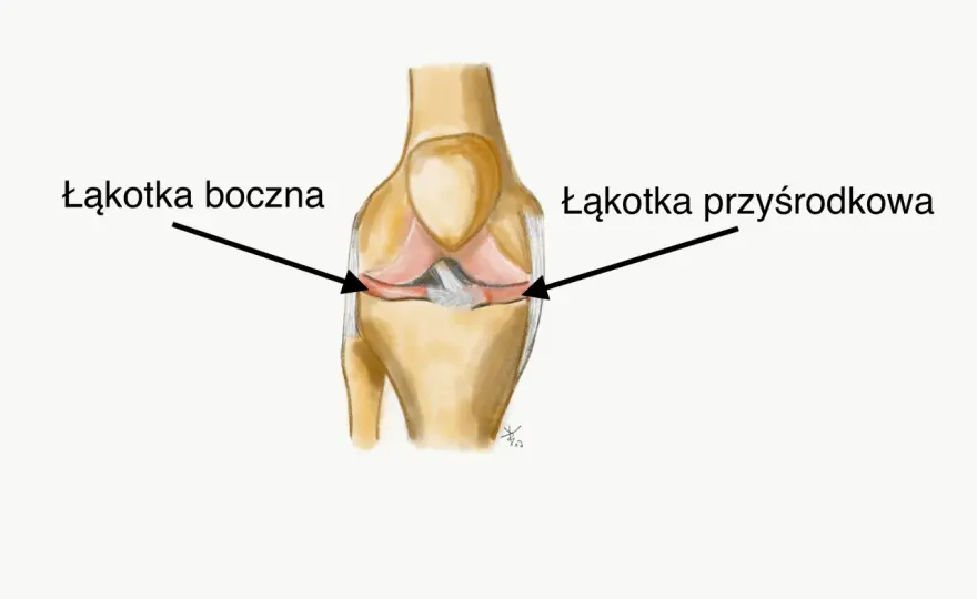 Uszkodzona łąkotka - leczyć czy operować? Objawy i rehabilitacja