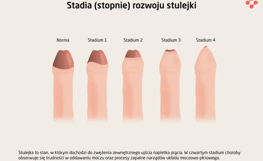 Stulejka - Kiedy to norma, a kiedy wymaga leczenia?