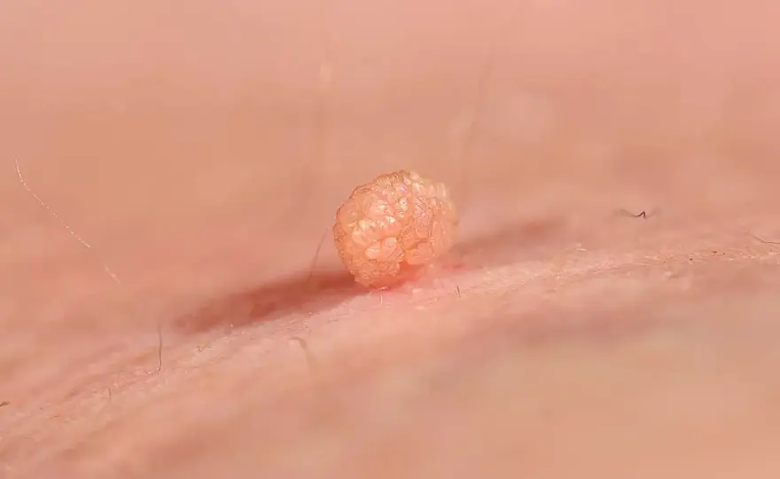 HPV - Czy to tylko kurzajki? Objawy, leczenie, szczepienia