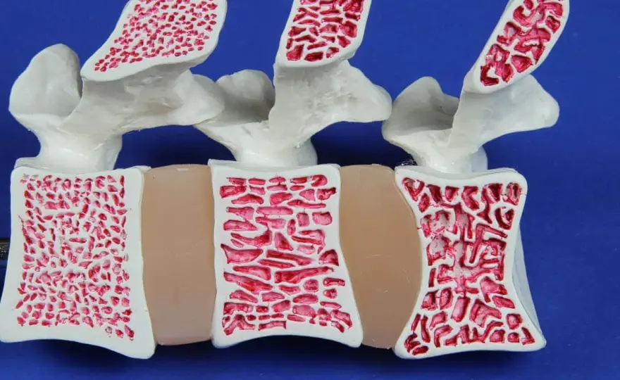 Osteopenia - Co oznacza wynik i jak wzmocnić kości?