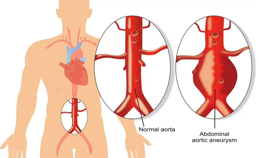 Aorta - budowa, choroby i objawy. Czy grozi Ci tętniak?