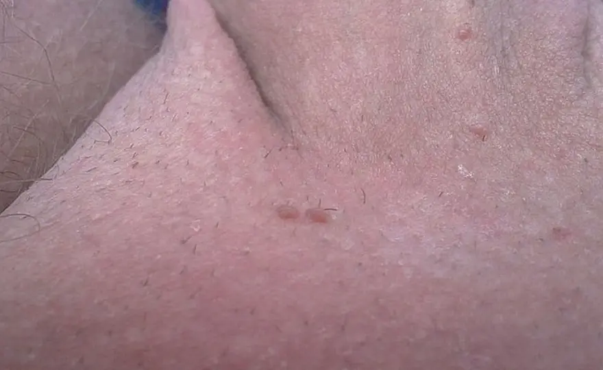 Kłykciny kończyste - objawy, leczenie i profilaktyka HPV