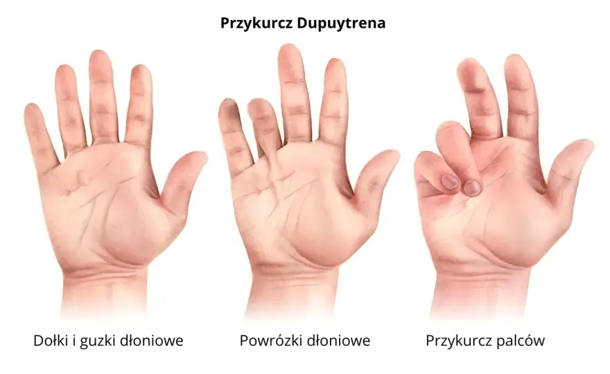Przykurcz Dupuytrena - Leczenie, objawy, rehabilitacja. Kiedy działać?