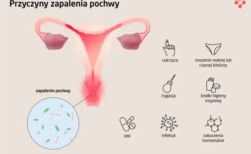 Pochwa - anatomia, wydzielina, infekcje. Jak dbać o zdrowie?