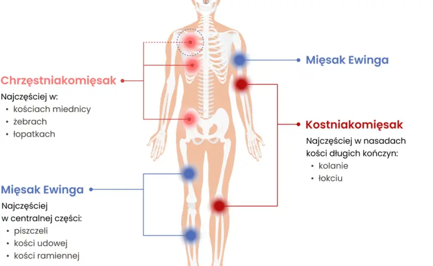 Mięsak - objawy, diagnostyka, leczenie. Jak odróżnić od urazu?