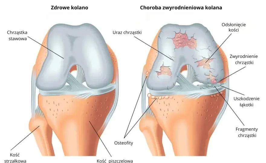 Zwyrodnienie stawów - objawy, leczenie i co naprawdę pomaga?