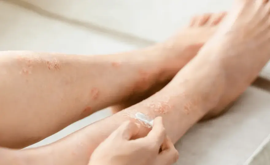 Locoid Lipocream - jak stosować go bezpiecznie i bez błędów?