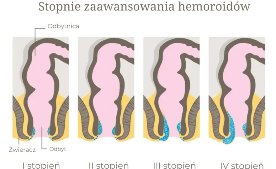 Hemoroidy - objawy i leczenie - Jak skutecznie przynieść sobie ulgę?
