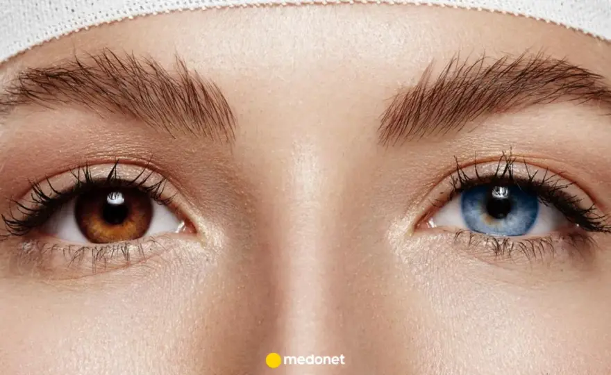 Heterochromia - Kiedy różnobarwne oczy to choroba?