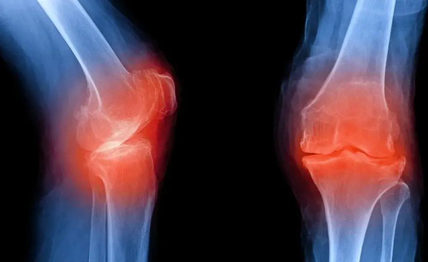 Osteofity - czy zawsze bolą? Leczenie, fizjoterapia i objawy alarmowe