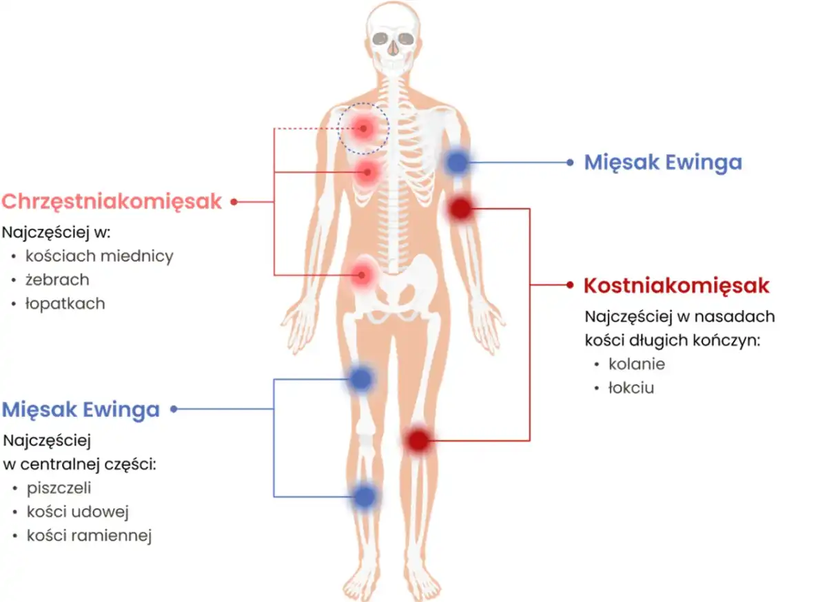 Mięsak - objawy, diagnostyka, leczenie. Jak odróżnić od urazu?