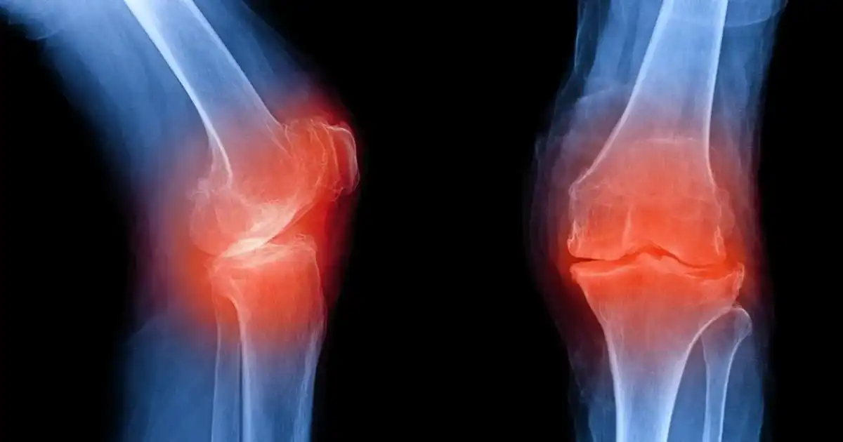 Osteofity - czy zawsze bolą? Leczenie, fizjoterapia i objawy alarmowe