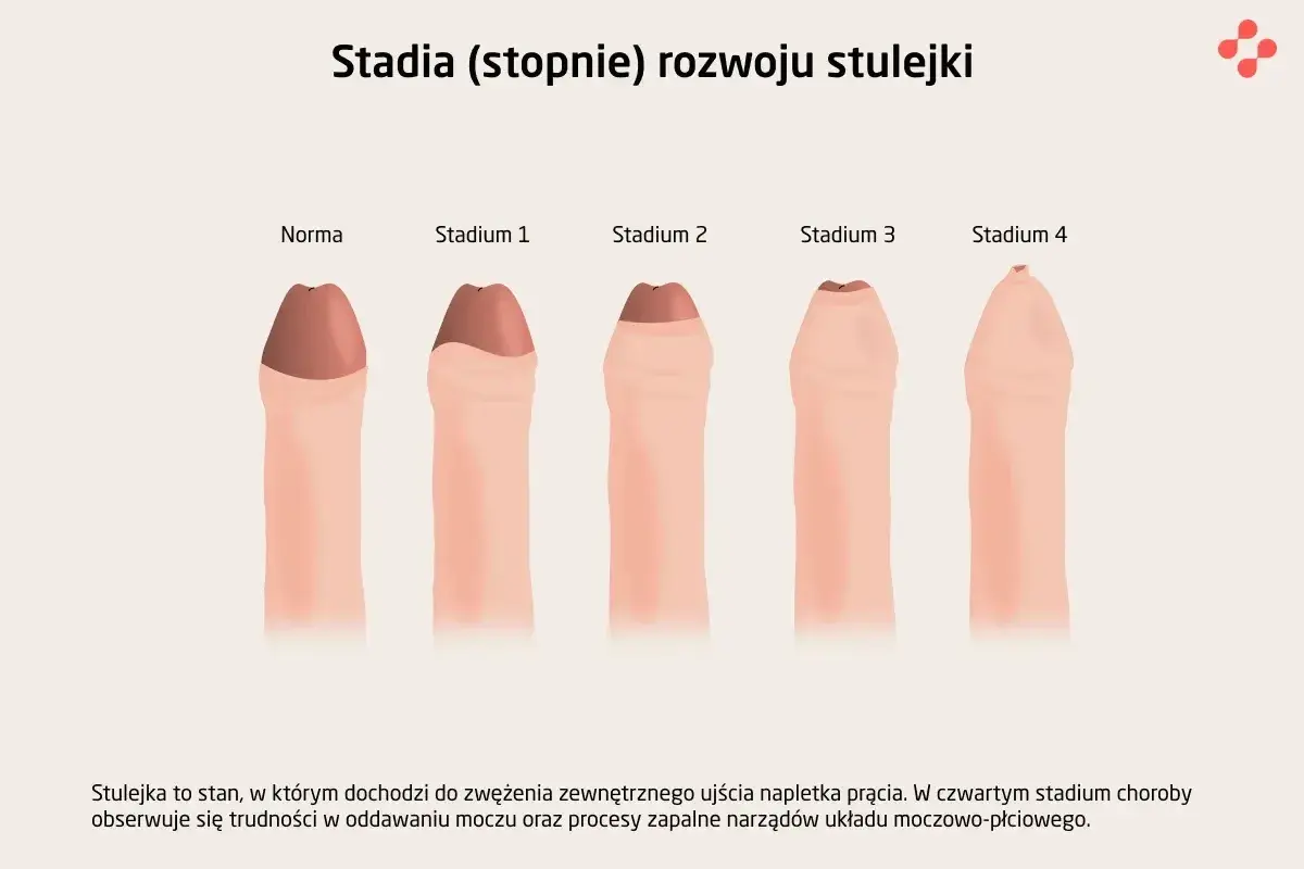Ilustracja pokazuje stadia rozwoju stulejki, od normy do stadium 4, gdzie widoczne są trudności z oddawaniem moczu.
