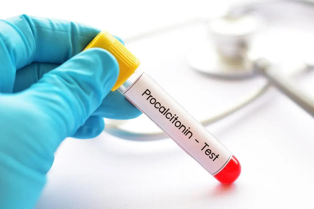 Ręka w niebieskiej rękawiczce trzyma probówkę z napisem "Procalcitonin - Test".