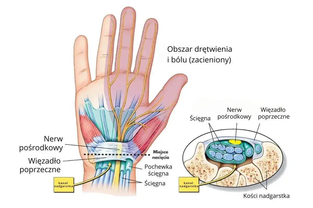 Anatomia dłoni z zaznaczonym nerwem pośrodkowym i więzadłem poprzecznym. Kość promieniowa jest częścią nadgarstka.
