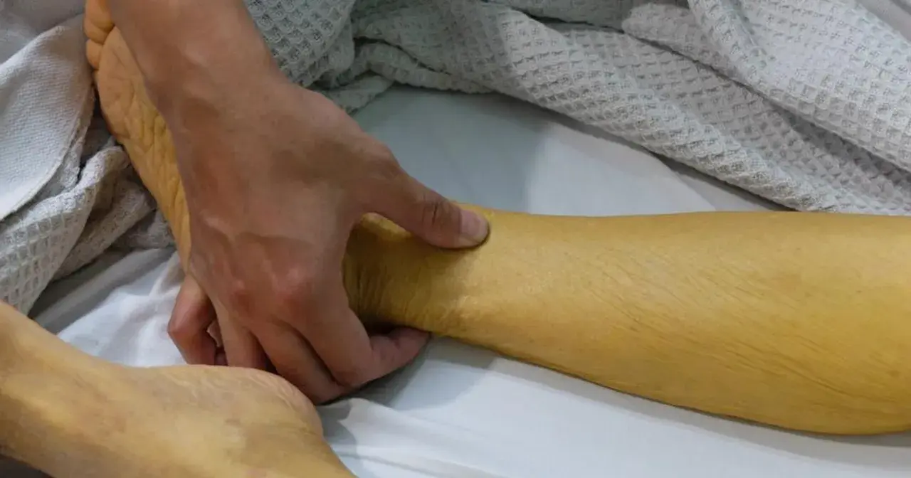 Dłoń bada zażółconą skórę nogi, widoczne objawy żółtaczki.