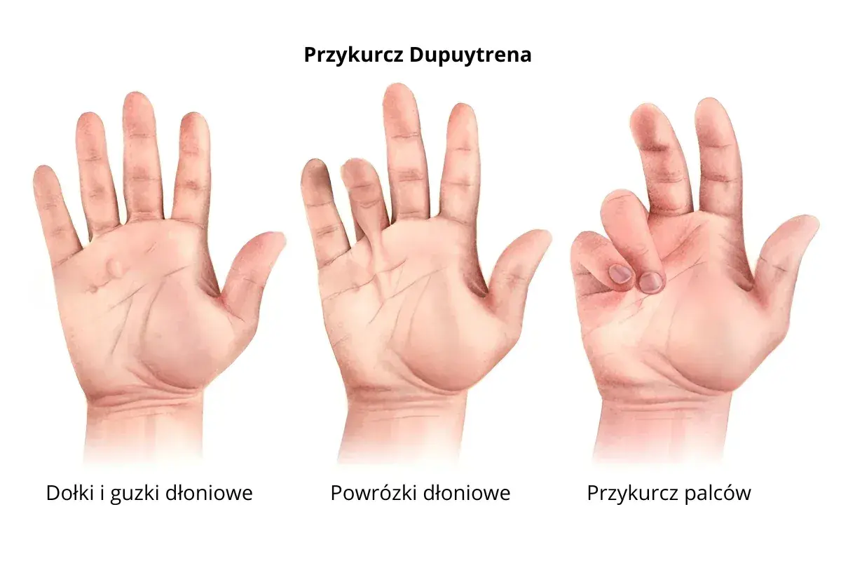 Trzy dłonie pokazujące postęp przykurczu Dupuytrena: zdrowe, z powrózkami i z przykurczem palców.