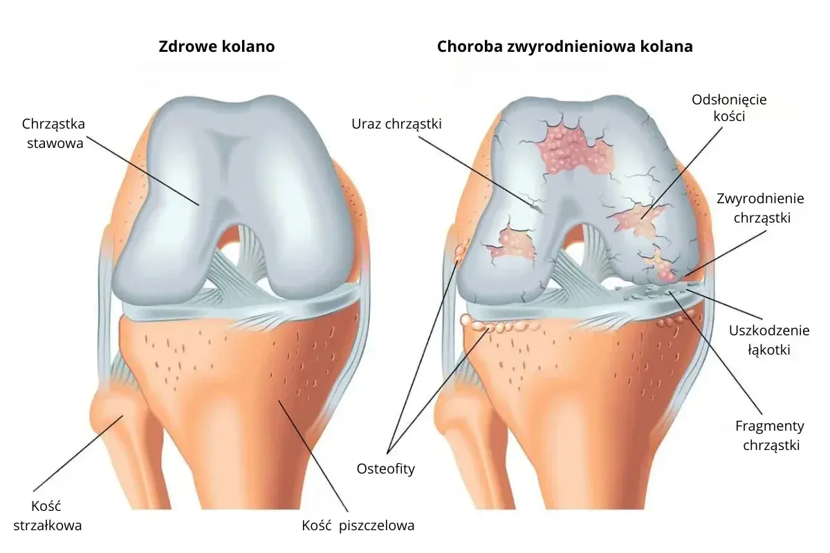 Porównanie zdrowego kolana z kolanem dotkniętym chorobą zwyrodnieniową, ukazujące uszkodzenia chrząstki i kości.